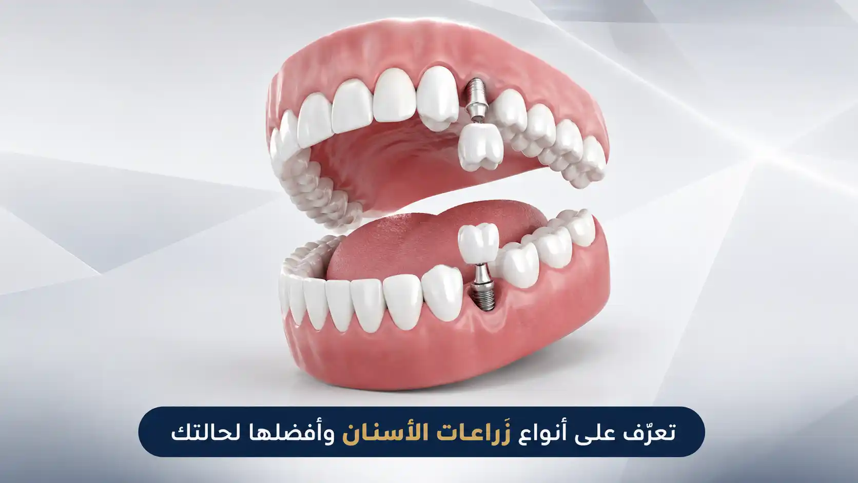 أنواع زراعات الأسنان