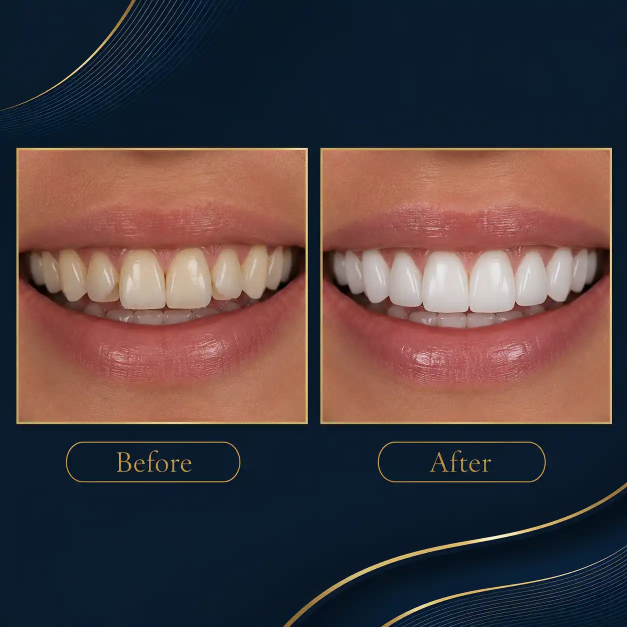 ابتسامة هوليود 2