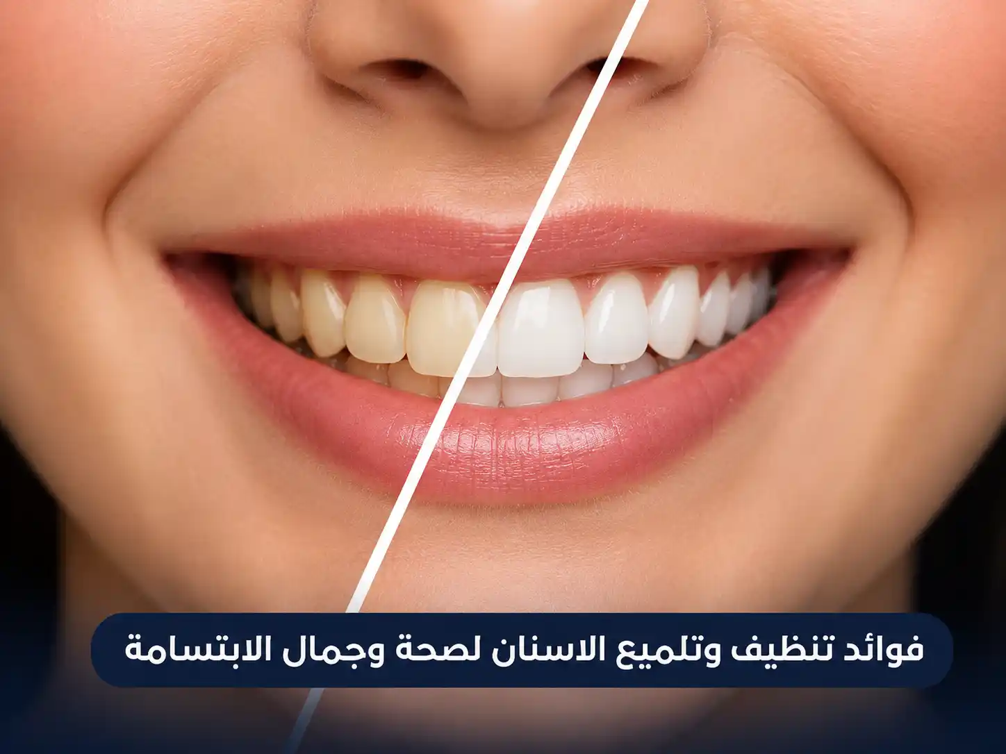 تنظيف وتلميع الاسنان بدون ألم